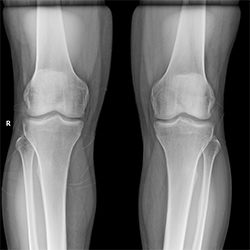 Bilateral Knee AP